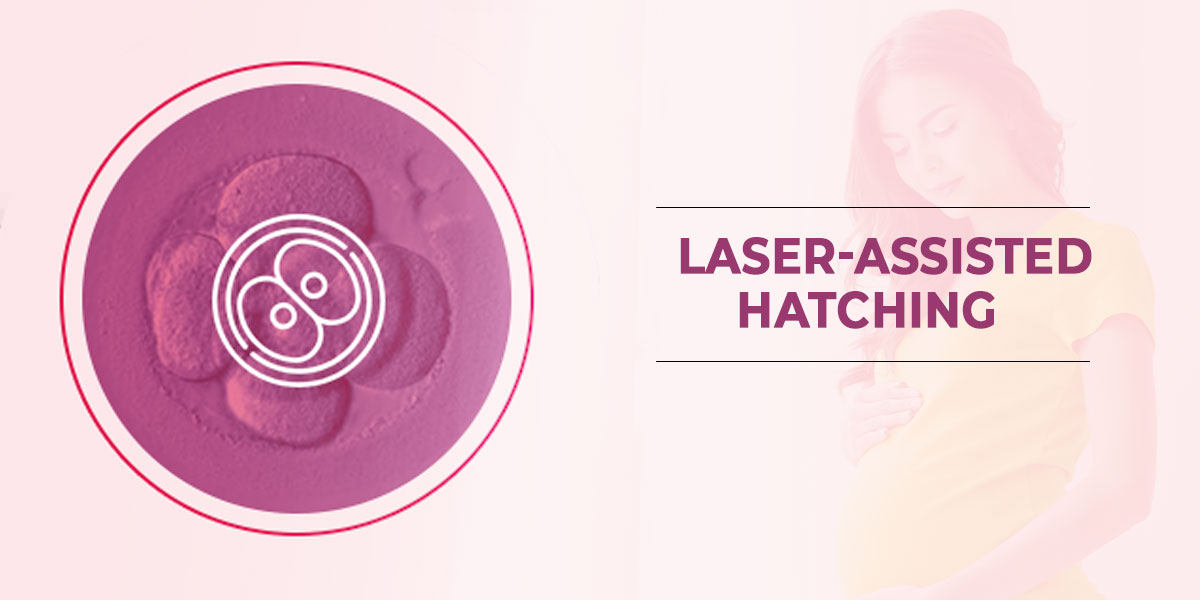 Laser-Assisted-Hatching